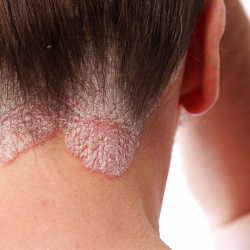 Traitement du psoriasis : Huile Psor